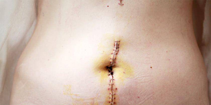 5 Cara Menghilangkan Keloid Bekas Operasi Caesar