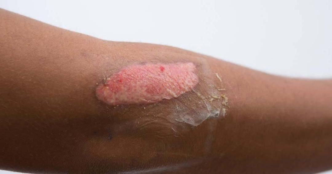 Ilustrasi - Medicalnewstoday.com