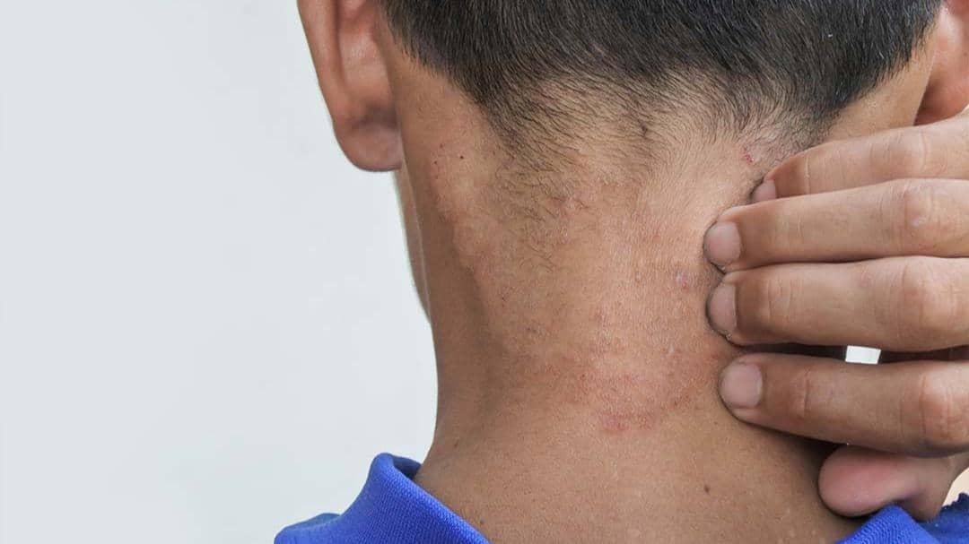 Gejala, Penyebab dan Cara Menghilangkan Panu pada Kulit Anak