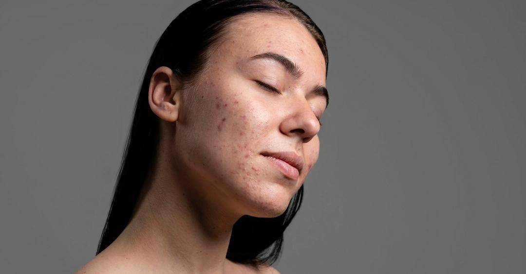 Mengenal Kandungan Tretinoin untuk Mengatasi Jerawat