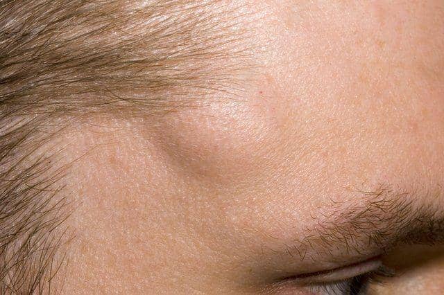 ilustrasi lipoma di area dahi (nhs.uk)