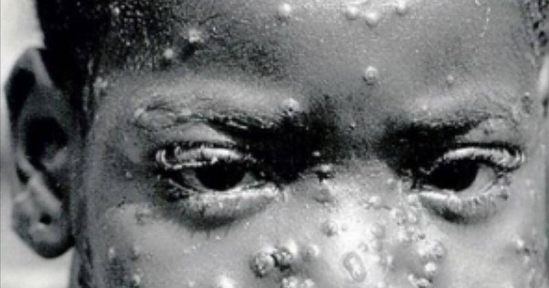 flickr.com/MONKEYPOX ZAIRE