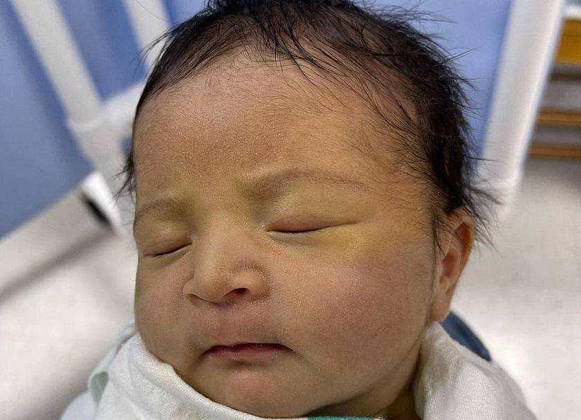 Jaundice bayi kuning - Instagram.com/melissammerr