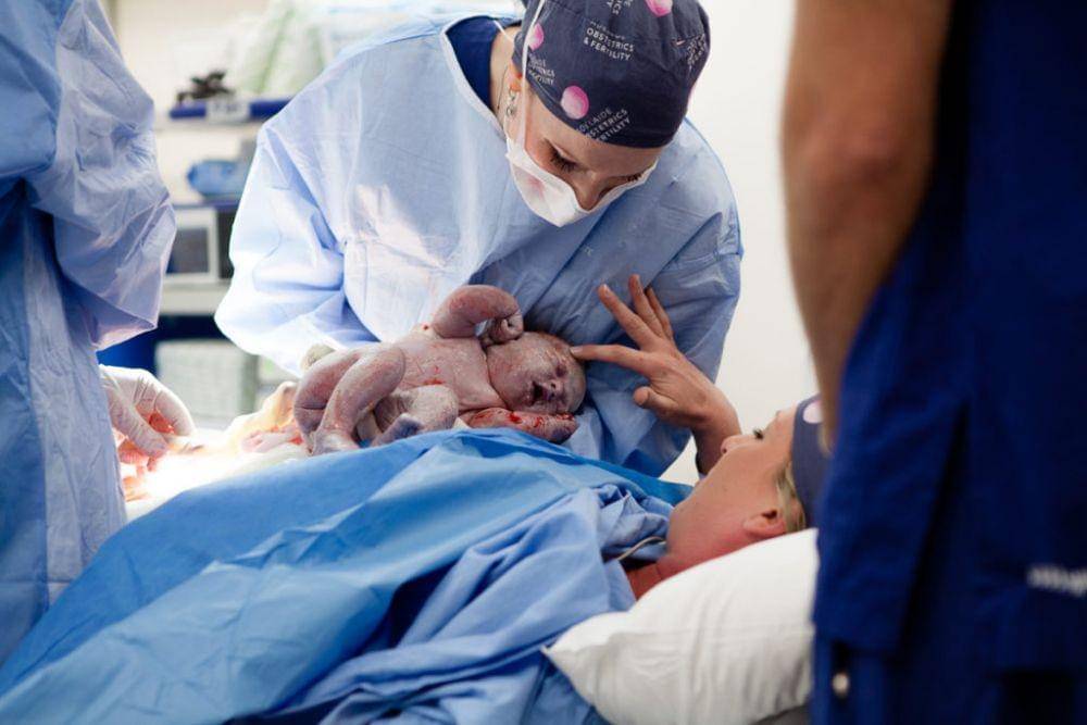 ilustrasi operasi caesar (adelobs.com.au)