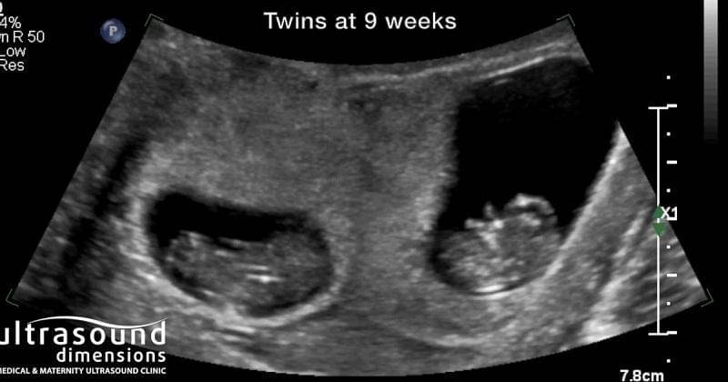 Youtube/Ultrasound Ireland