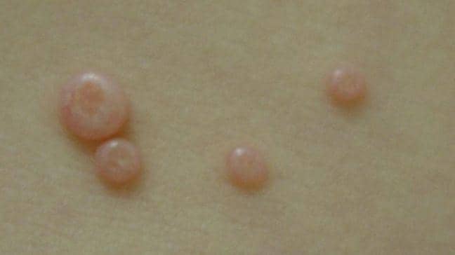 7 Penyebab Jerawat di Penis, Hindari Hal Ini!