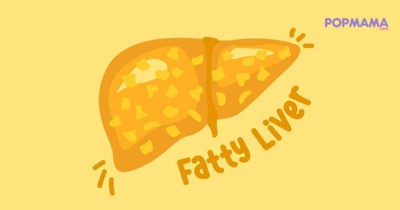Mengenal Fatty Liver, Gangguan Kesehatan yang Kerap Disangka Maag