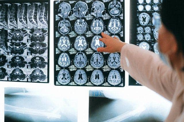 Tumor yang dialaminya tidak bersifat kanker