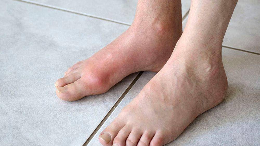 6 Ciri-Ciri Asam Urat di Kaki