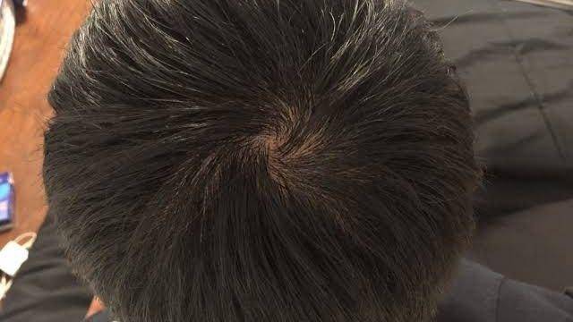 Hairlosstalk.com/Htn209