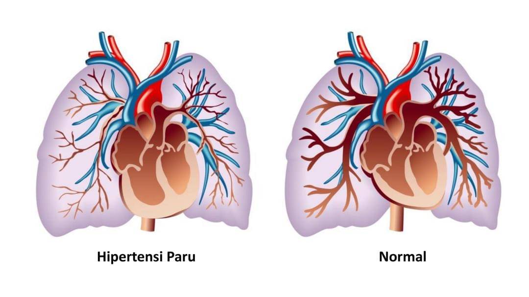 Presentasi dr. Rizky Adriansyah dari acara Media Health Forum