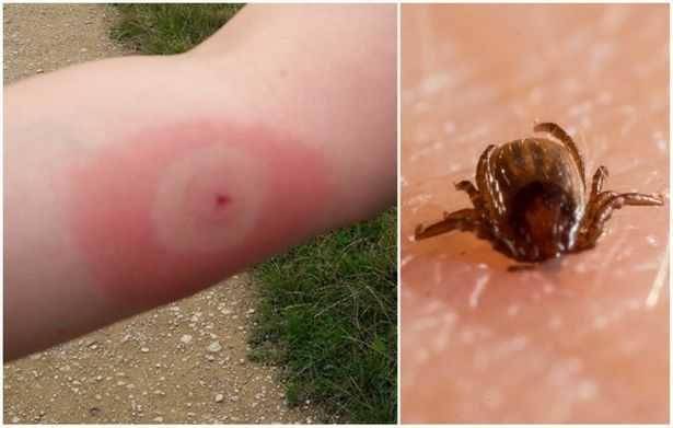 Apa Itu Penyakit Lyme yang Diderita Justin Timberlake?