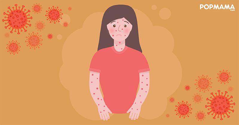 6 Cara Mencegah Cacar Monyet atau Mpox pada Anak Kecil