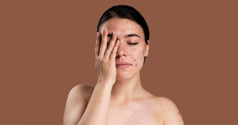 Cara Mengatasi Kulit Meradang Akibat Salah Pakai Skincare
