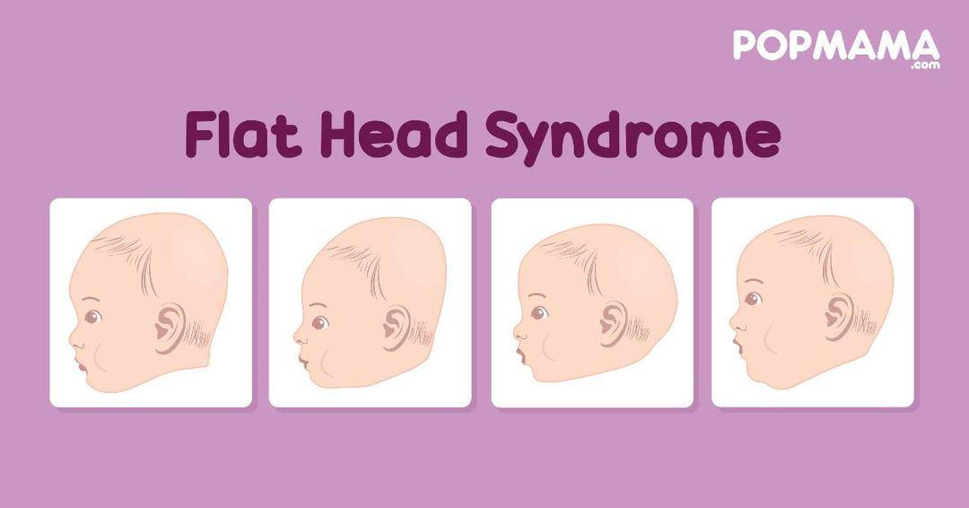 Jenis Kepala Peang pada Bayi yang Perlu Mama Ketahui