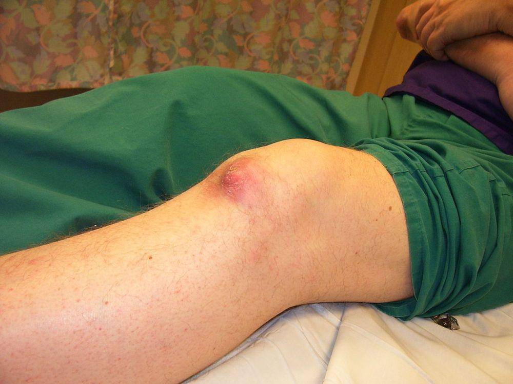 7 gejala asam urat di kaki