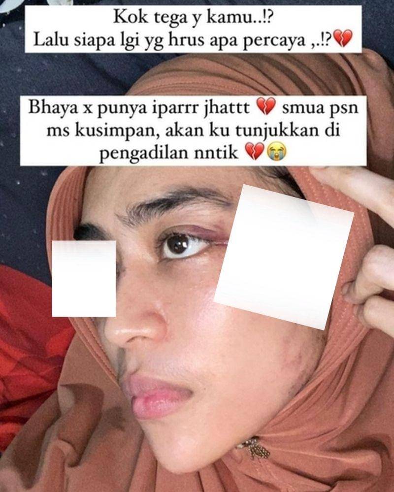 Gambar yang menunjukkan luka kekerasan sudah disensor - Instagram.com/tiara_luxury_boutiquee
