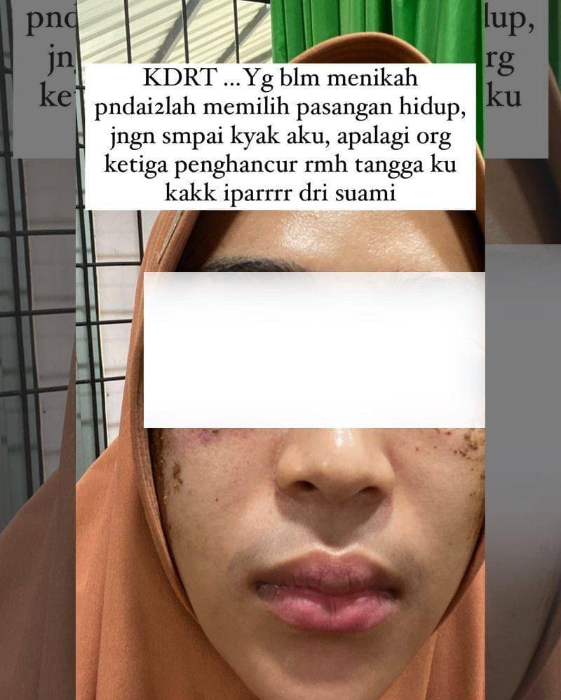 Gambar yang menunjukkan luka kekerasan sudah disensor - Instagram.com/tiara_luxury_boutiquee