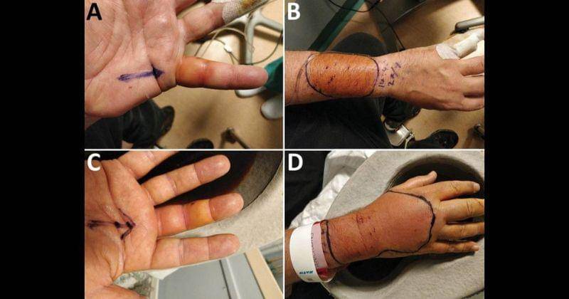 Jones/Emerging Infectious Disease in Miami Herald