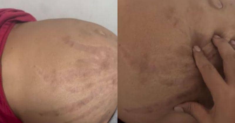 Perut Membesar Tak Wajar Akibat Minum Obat Tanpa Resep, Kenapa?