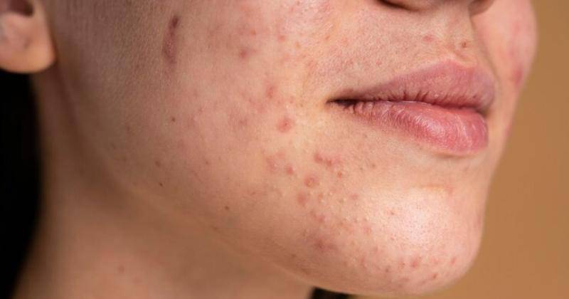 7 Penyebab Jerawat di Dagu, Beserta Cara Mengatasinya
