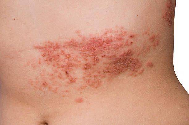 Herpes Zoster (pexels.com)