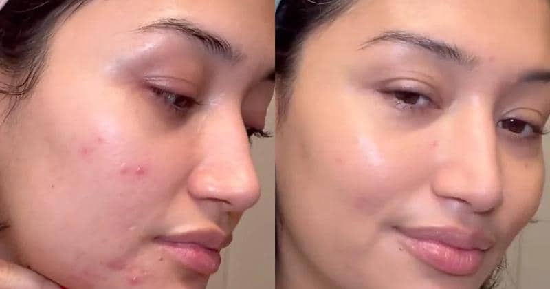 Cara Mengatasi Purging Akibat Retinol, Kamu Nggak Perlu Khawatir ...