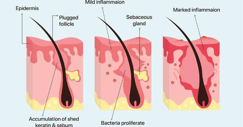 Cara Mengatasi Purging Akibat Retinol, Kamu Nggak Perlu Khawatir ...