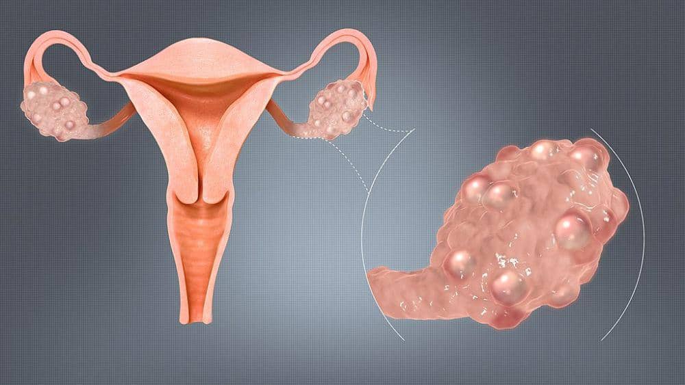 September Jadi Bulan Kesadaran PMOS: Mengenal Gangguan Hormonal pada Perempuan