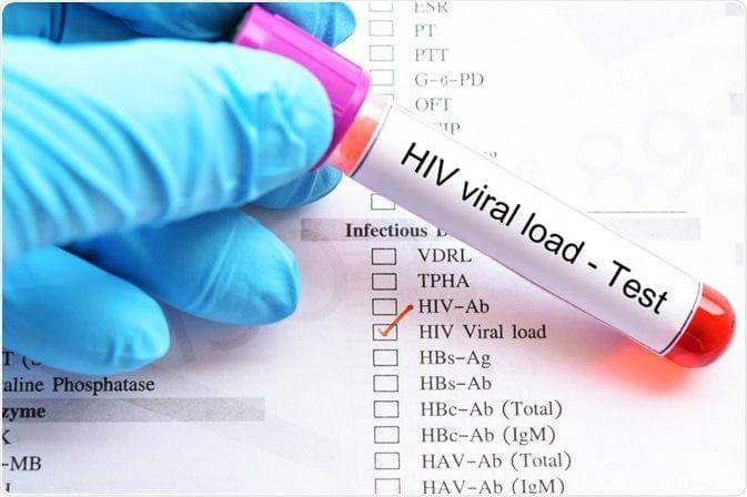 ilustrasi tes HIV (news-medical.net)