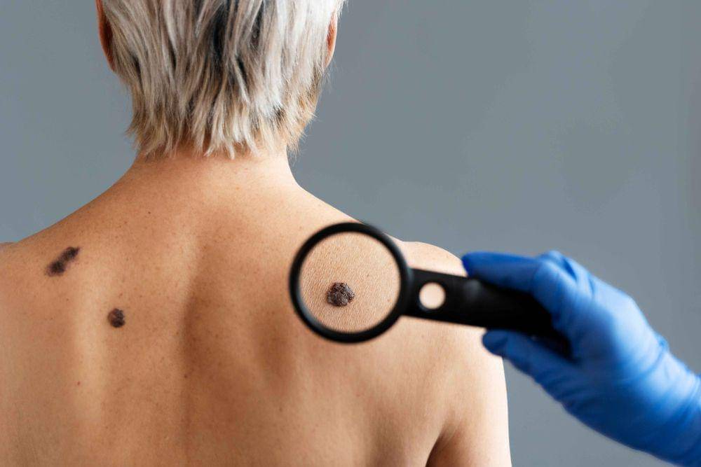 ilustrasi kanker kulit