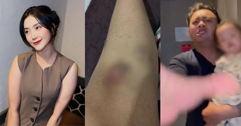 8 Fakta KDRT Adelia Septa dan Suami, Disiksa Selama 4 Jam