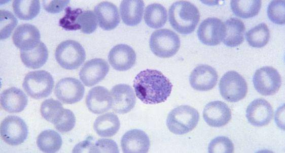 5 Jenis Malaria yang Berbahaya untuk Kesehatan, Kenali Gejalanya! 3.jpg