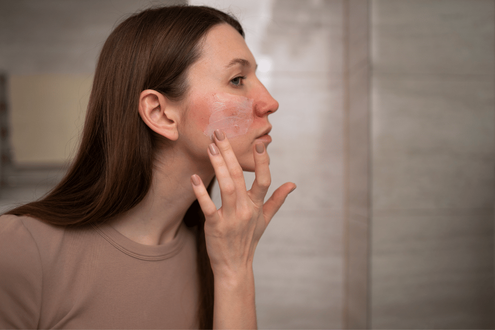 kulit wajah rosacea (6).png