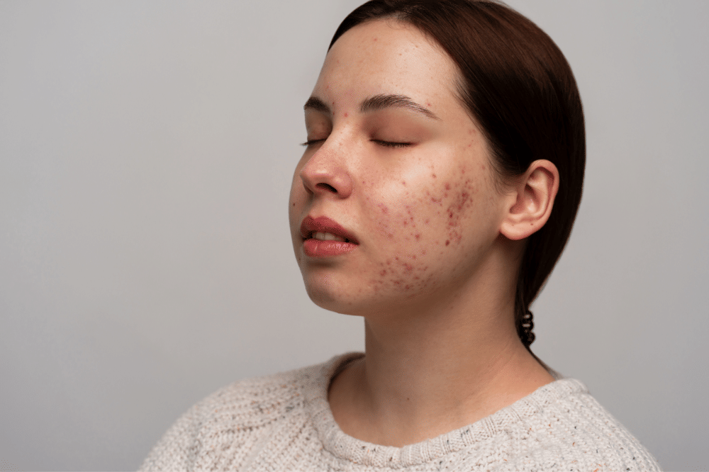 kulit wajah rosacea (6).png