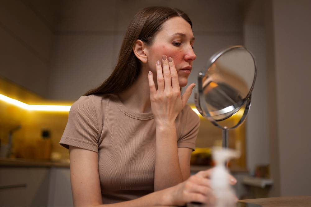 kulit wajah rosacea (1).png