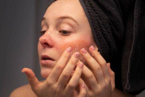 Apakah Lupus Bisa Sembuh_ Kenali Dampak dan Solusi Pengobatannya 2.jpg