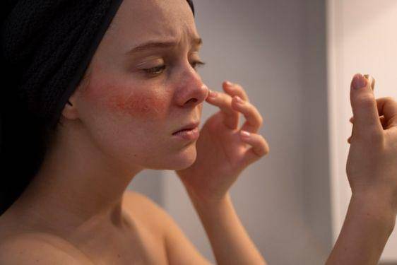 9 Fakta Penyakit Lupus, Termasuk dalam Penyakit Autoimun 5.jpg