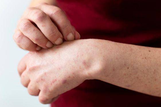 9 Fakta Penyakit Lupus, Termasuk dalam Penyakit Autoimun 6.jpg