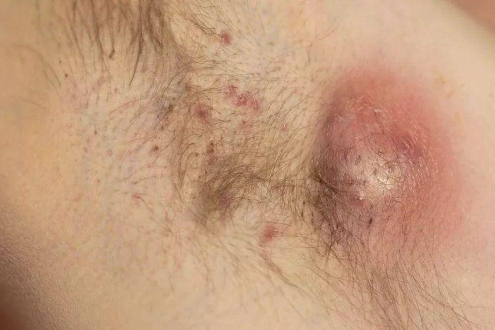 hidradenitis suppurativa 2.jpg