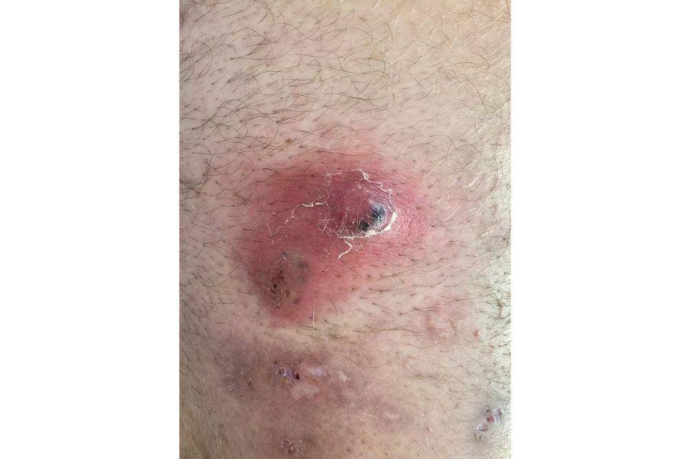 hidradenitis suppurativa 1.jpg