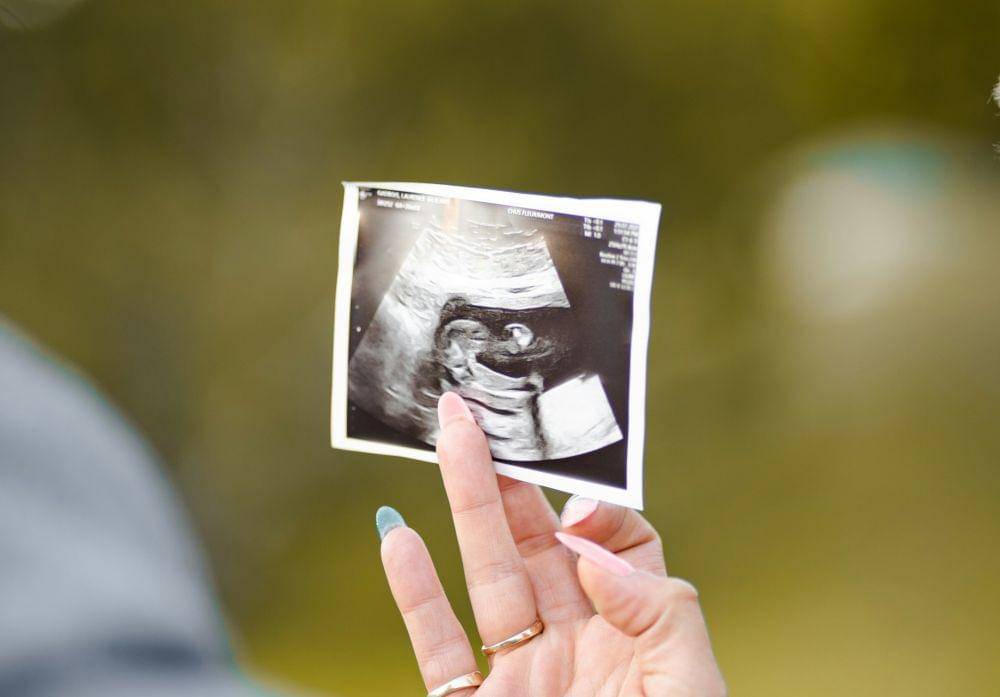 ilustrasi foto USG kehamilan (unsplash.com/Dave Goudreau)