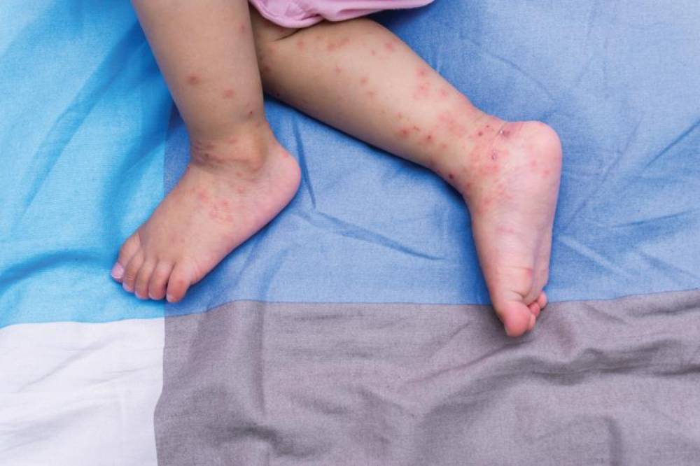 HFMD tampak di kaki