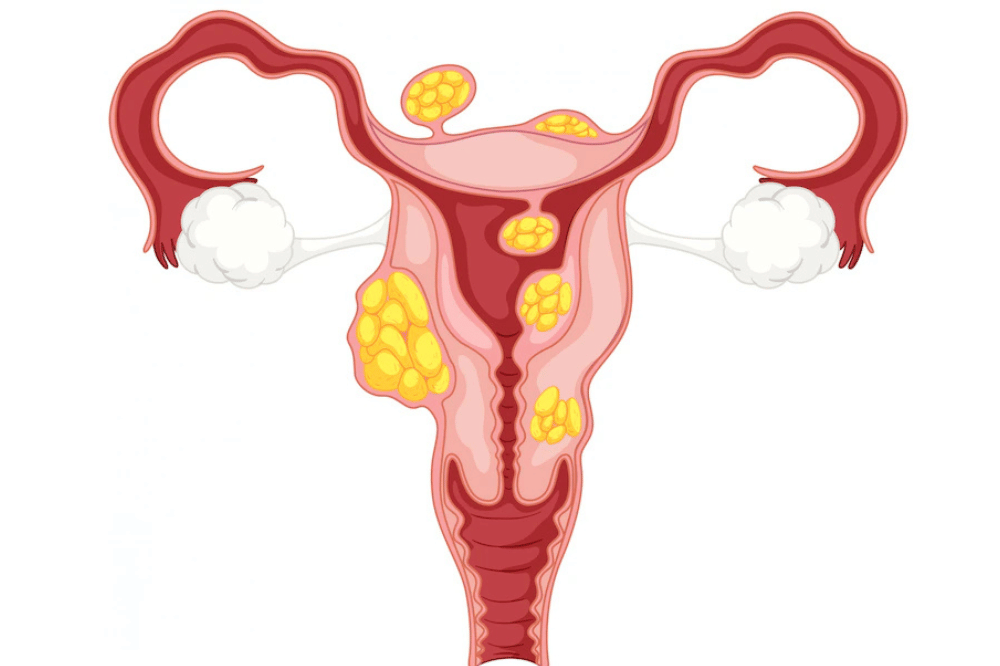 Fibroid Rahim.png