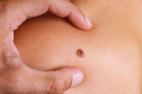 Apa Perbedaan Tumor dan Kanker_ Kenali Lebih Jelas, Yuk! 2.jpg