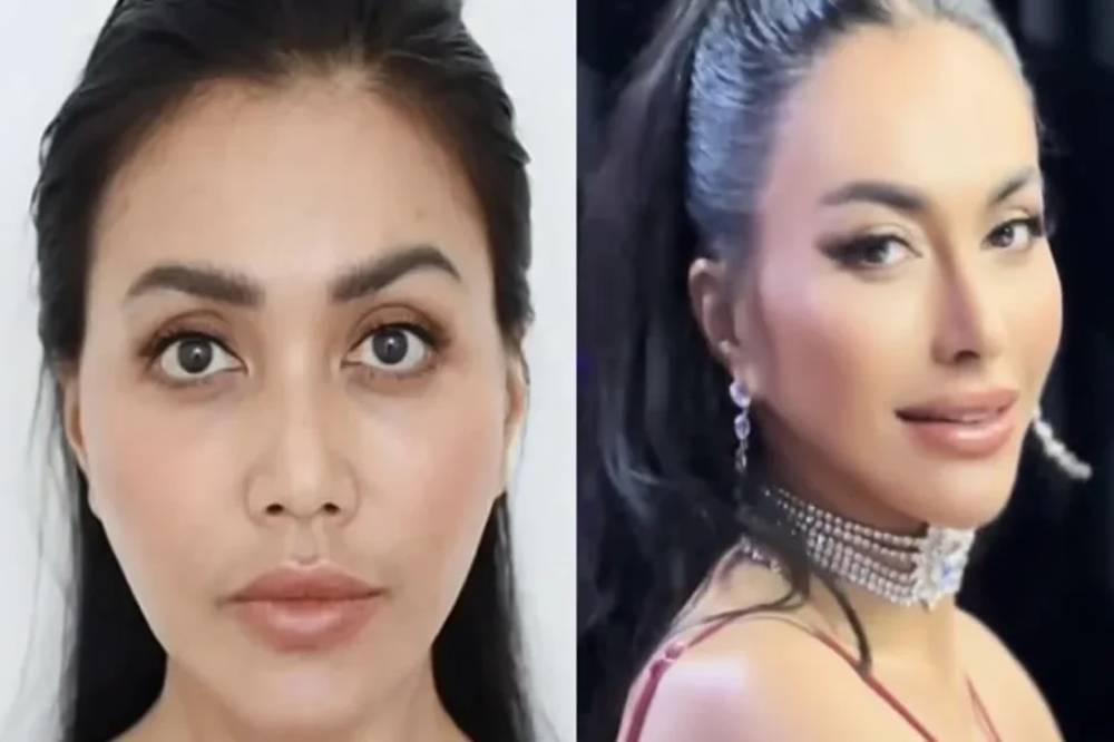 Denada operasi plastik di bagian hidung