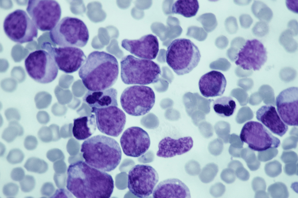 Sel leukemia