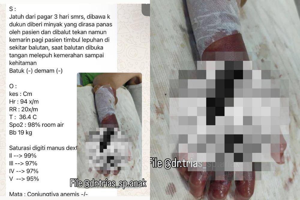 Jangan Buru-Buru Dipijat! Begini Penanganan Tepat saat Anak Jatuh