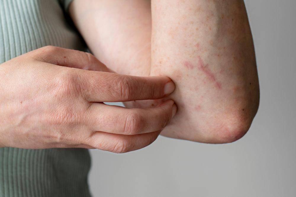 Waspada! Ini Tanda Alergi Parfum pada Kulit yang Jarang Disadari