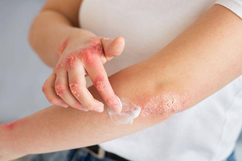 Waspada! Ini Tanda Alergi Parfum pada Kulit yang Jarang Disadari